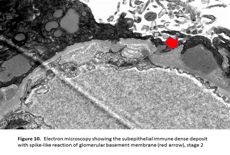 membranous glomerulonephritis spike and dome